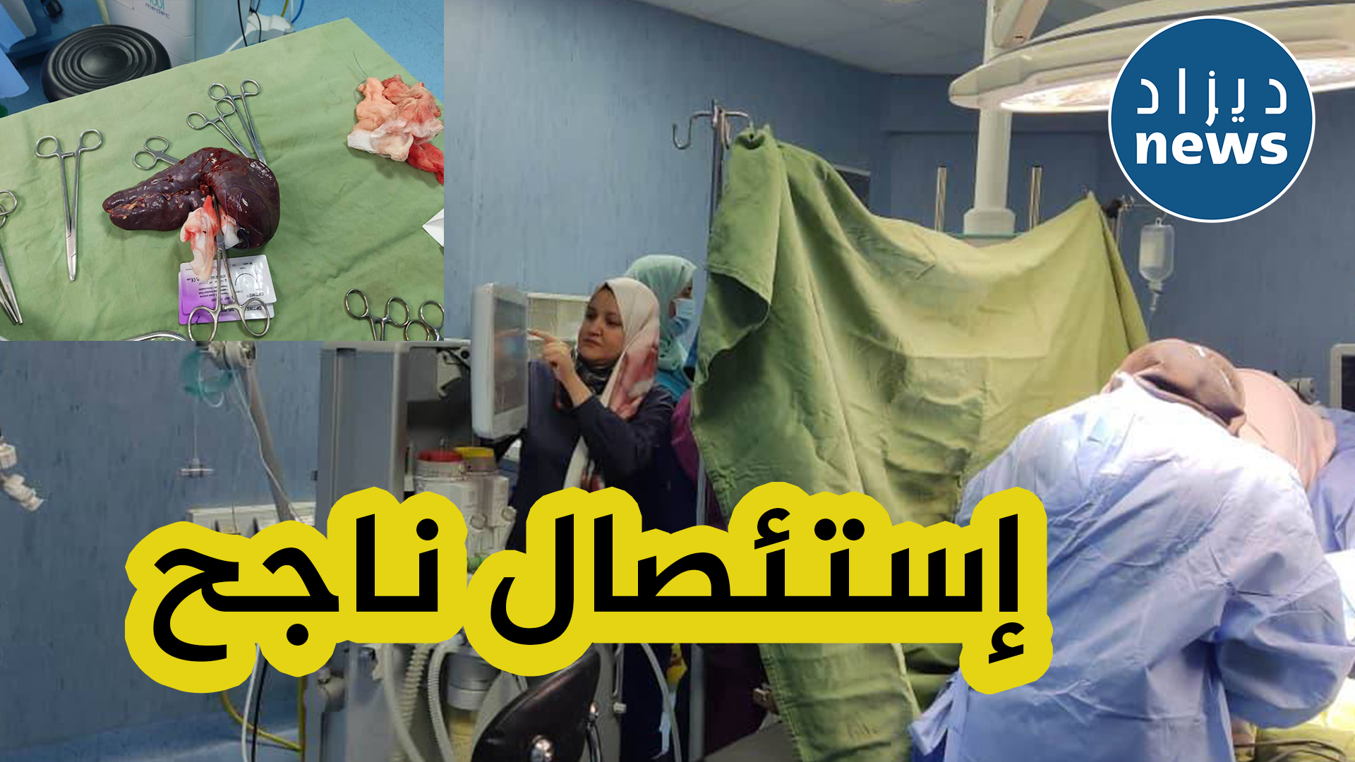 قالمة: فريق طبي بمستشفى الأم والطفل يتمكن من استئصال طحال طفل بلغ المرحلة الرابعة من التضخم