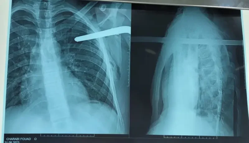 شاهد بالصور .. أطباء مستشفى مصطفى باشا ينقذون مراهق بعد أن إخترقت قطعة حديدية صدره